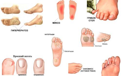 Hyperkeratosis ng mga paa, mycosis ng mga paa, fungus ng mga paa, mais, kuko halamang-singaw, kuko ng ingrown