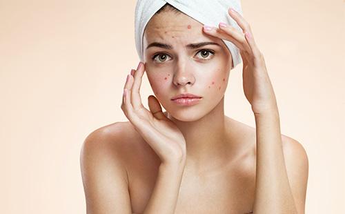 Acne sul viso della ragazza