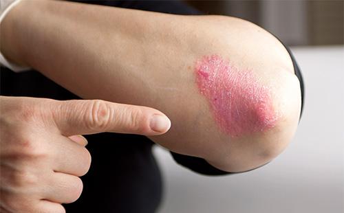 Ang psoriasis sa siko